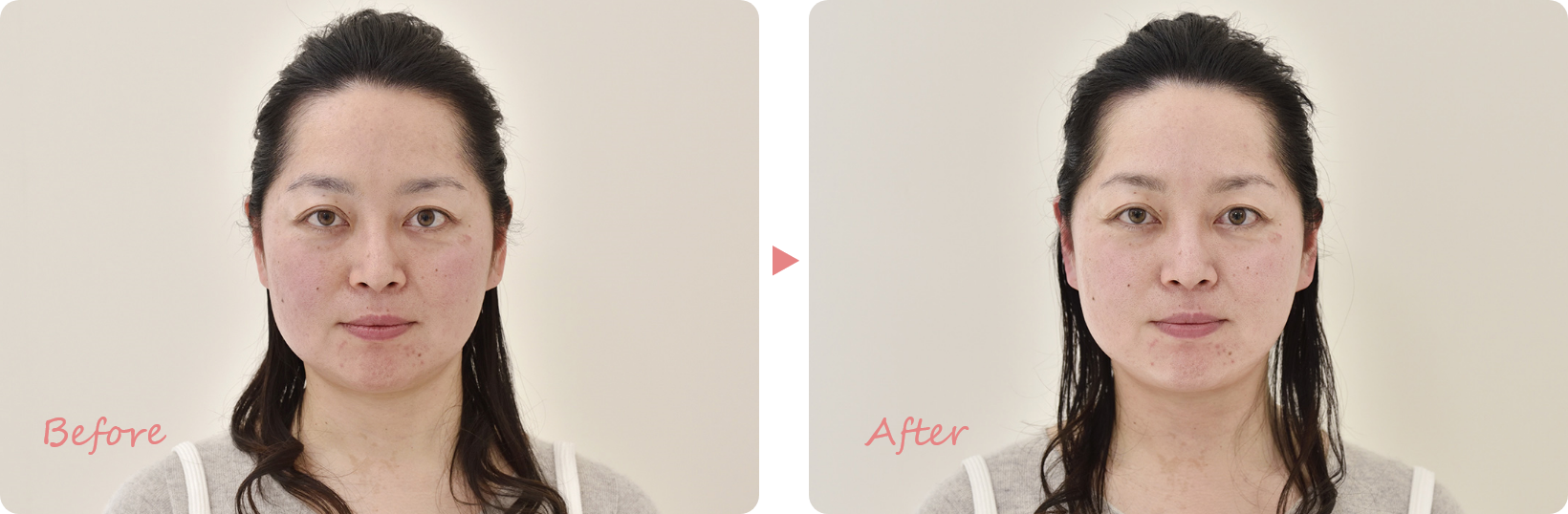 お顔そりエステ・毛穴ケア　体験例