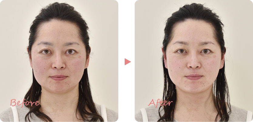 お顔そりエステ・毛穴ケア　体験例